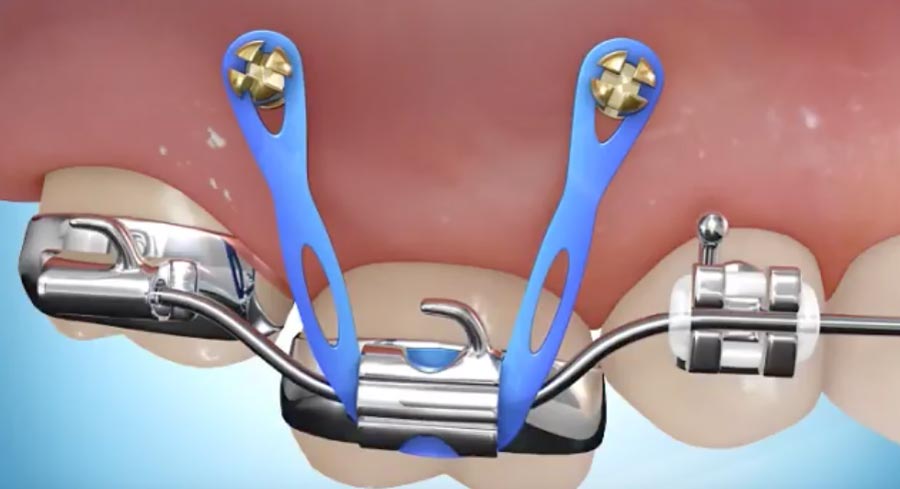 micro-ancrage orthodontique