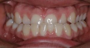 Position initiale des dents - Vue de face.